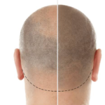 Comprehensive Guide to Scalp Micropigmentation in Sydney