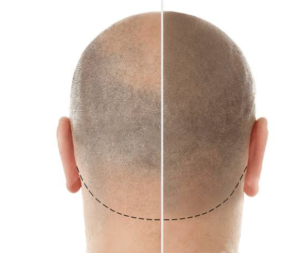 Comprehensive Guide to Scalp Micropigmentation in Sydney